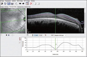 網膜OCT10層画像