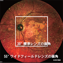 マルチカラー対応55°ワイドフィールドレンズ