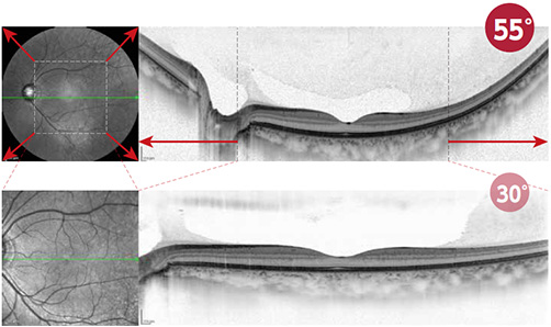 55°ワイドフィールドOCT