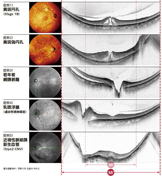 コンフォーカルSLO眼底画像との組み合わせ