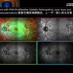 増殖性糖尿病網膜症、レーザー跡と新生血管
