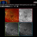 増殖性糖尿病網膜症とレーザー跡